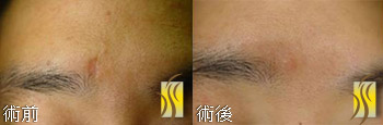 3D變頻飛梭雷射 術前術後對比圖