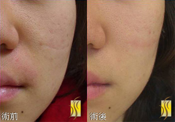 3D變頻飛梭雷射 術前術後對比圖