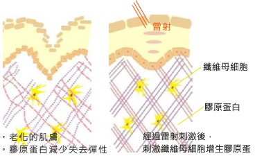 V 型修容術